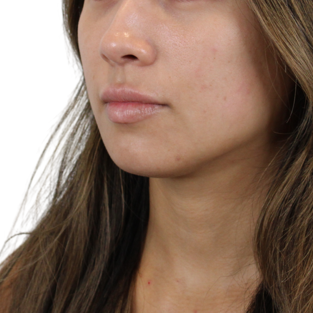 Lip Filler Before & After Gallery - Patient 124986 - Image 3