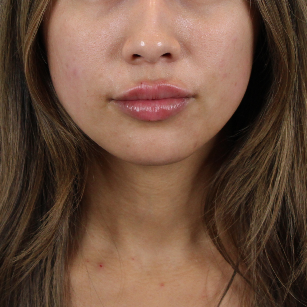 Lip Filler Before & After Gallery - Patient 124986 - Image 2
