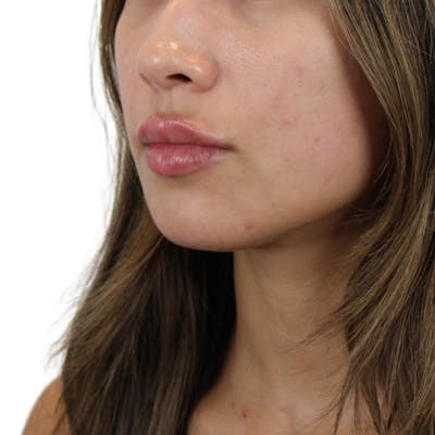 Lip Filler Before & After Gallery - Patient 124986 - Image 4