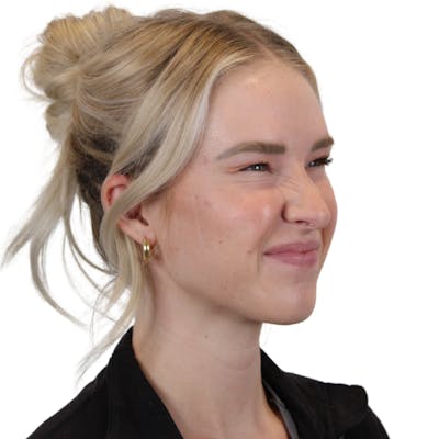 BOTOX  Before & After Gallery - Patient 334311 - Image 8