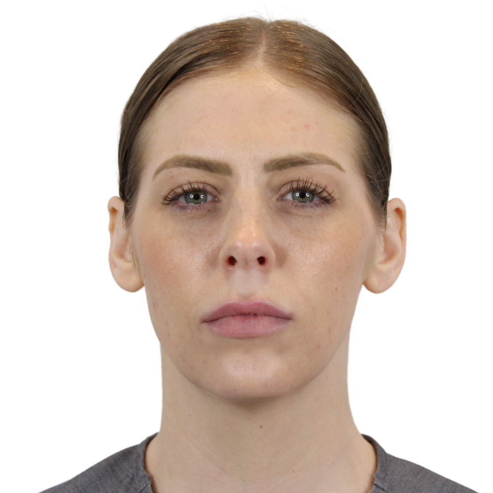 BOTOX  Before & After Gallery - Patient 240504 - Image 4