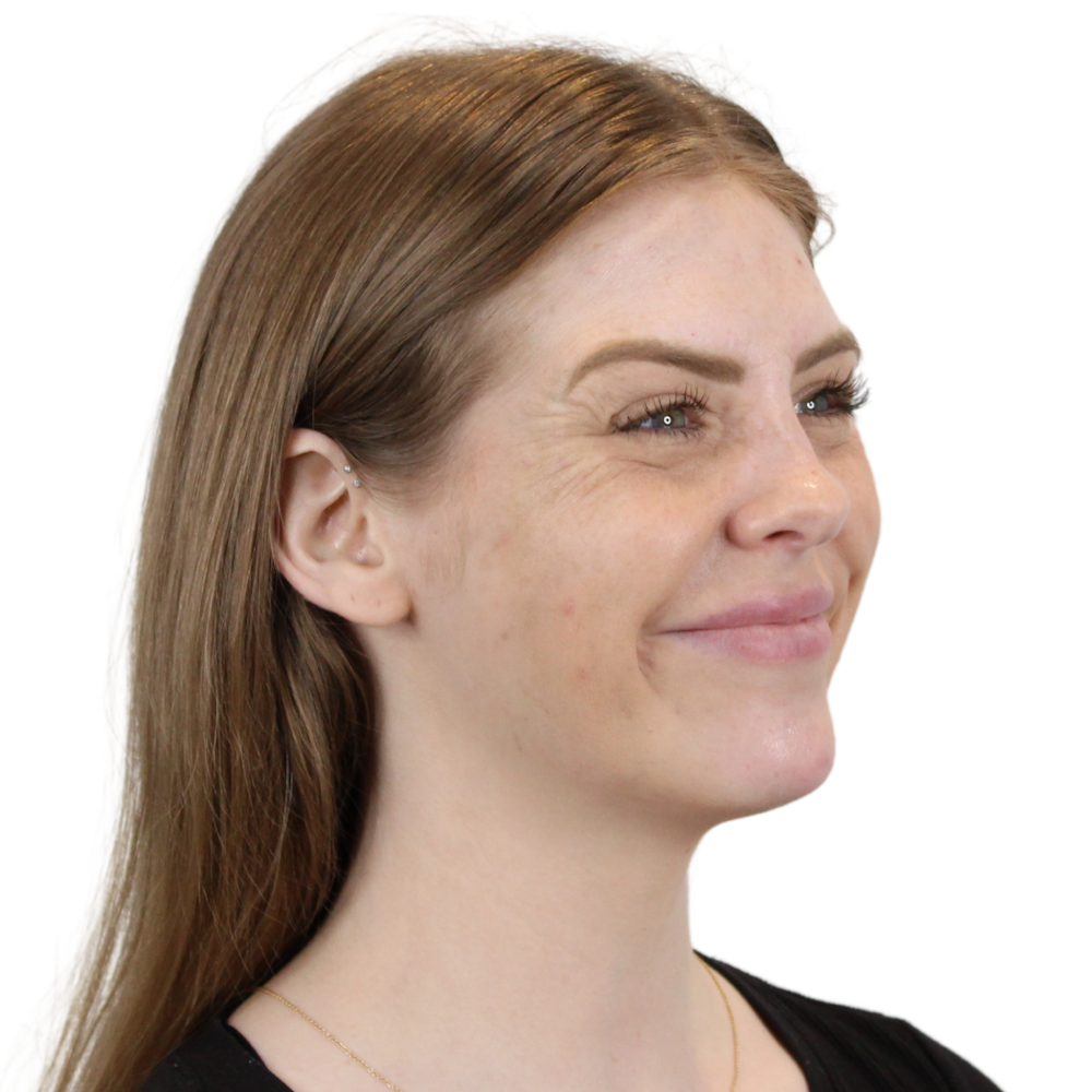 BOTOX  Before & After Gallery - Patient 240504 - Image 8