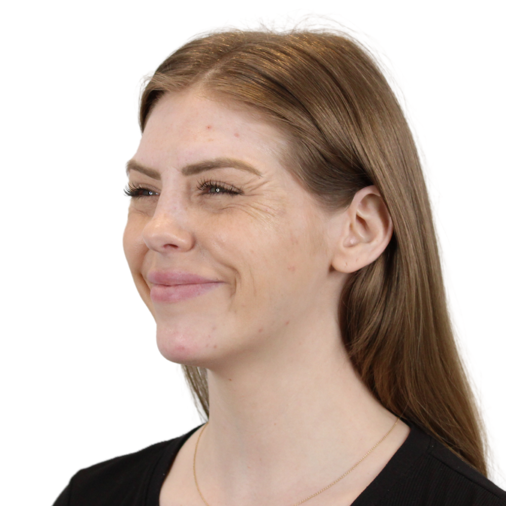BOTOX  Before & After Gallery - Patient 240504 - Image 5