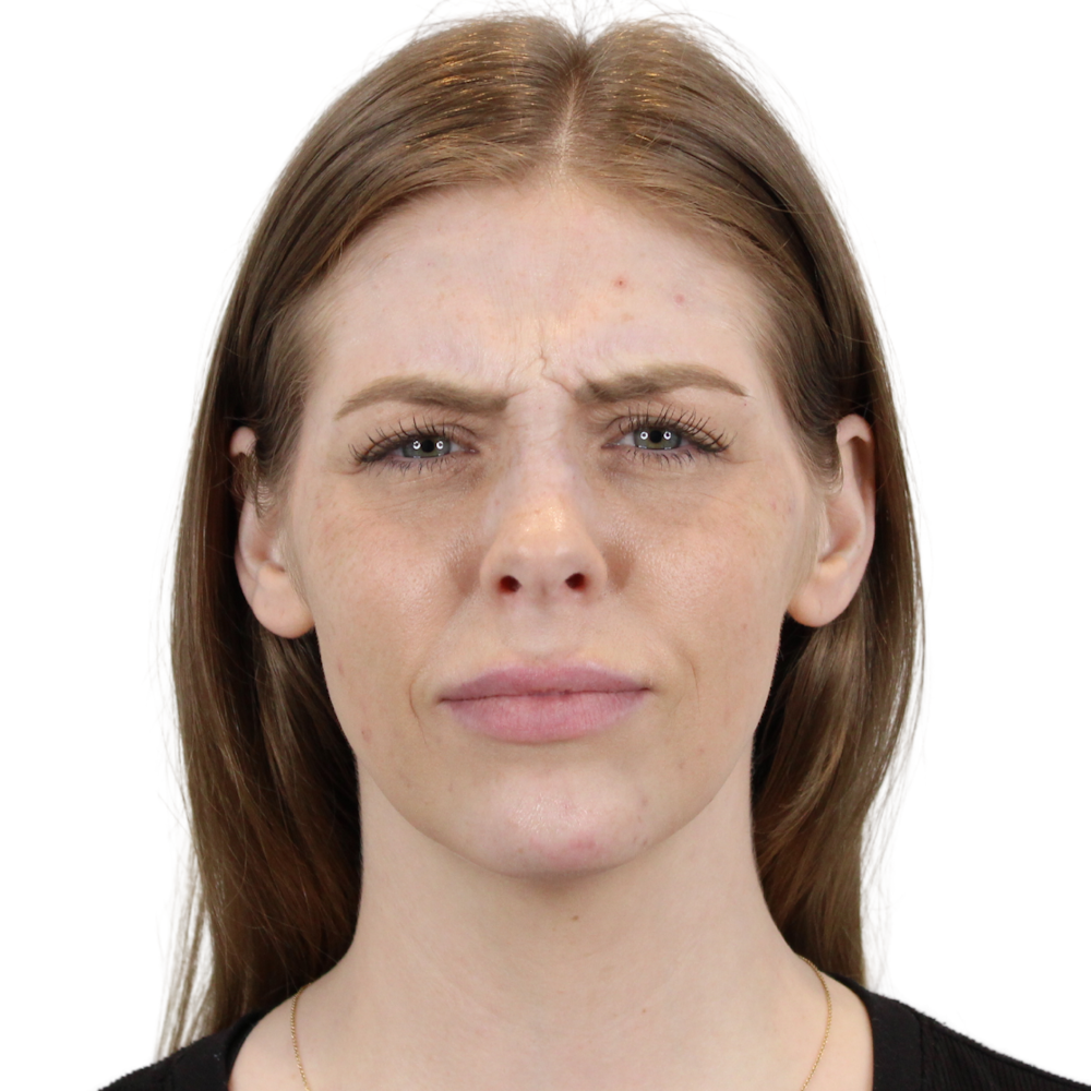 BOTOX  Before & After Gallery - Patient 240504 - Image 3