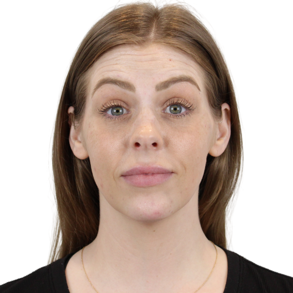 BOTOX  Before & After Gallery - Patient 240504 - Image 1