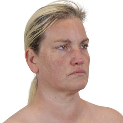 Sciton BBL HERO® Before & After Gallery - Patient 185206 - Image 4