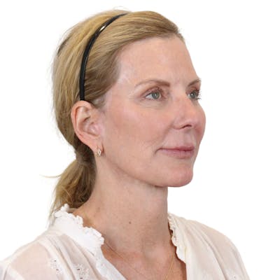 Deep Plane Facelift Before & After Gallery - Patient 207855 - Image 4