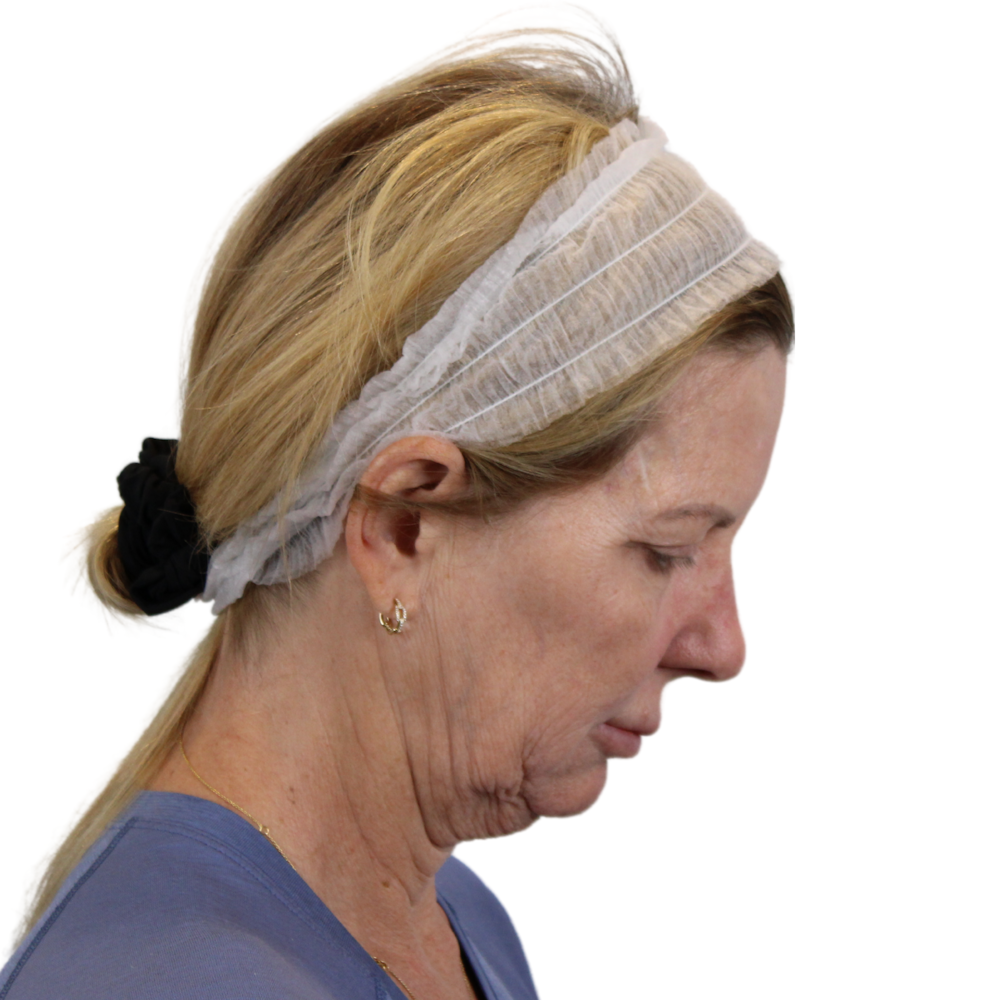 Deep Plane Facelift Before & After Gallery - Patient 207855 - Image 7