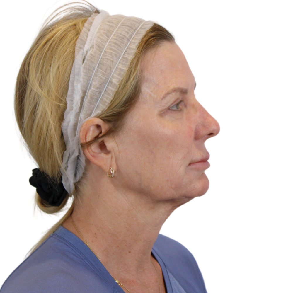Deep Plane Facelift Before & After Gallery - Patient 207855 - Image 5