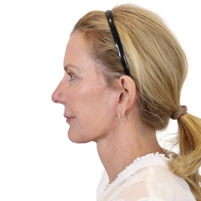 Deep Plane Facelift Before & After Gallery - Patient 207855 - Image 12
