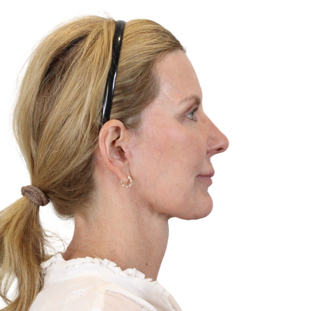 Deep Plane Facelift Before & After Gallery - Patient 207855 - Image 6