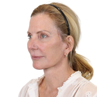 Deep Plane Facelift Before & After Gallery - Patient 207855 - Image 10