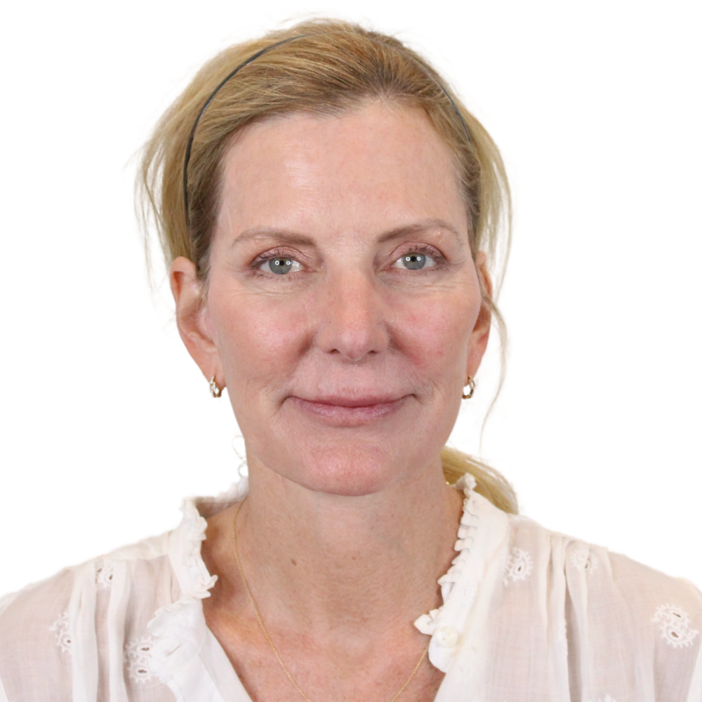 Deep Plane Facelift Before & After Gallery - Patient 207855 - Image 2