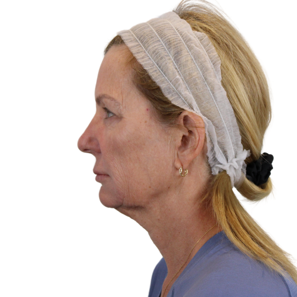 Deep Plane Facelift Before & After Gallery - Patient 207855 - Image 11