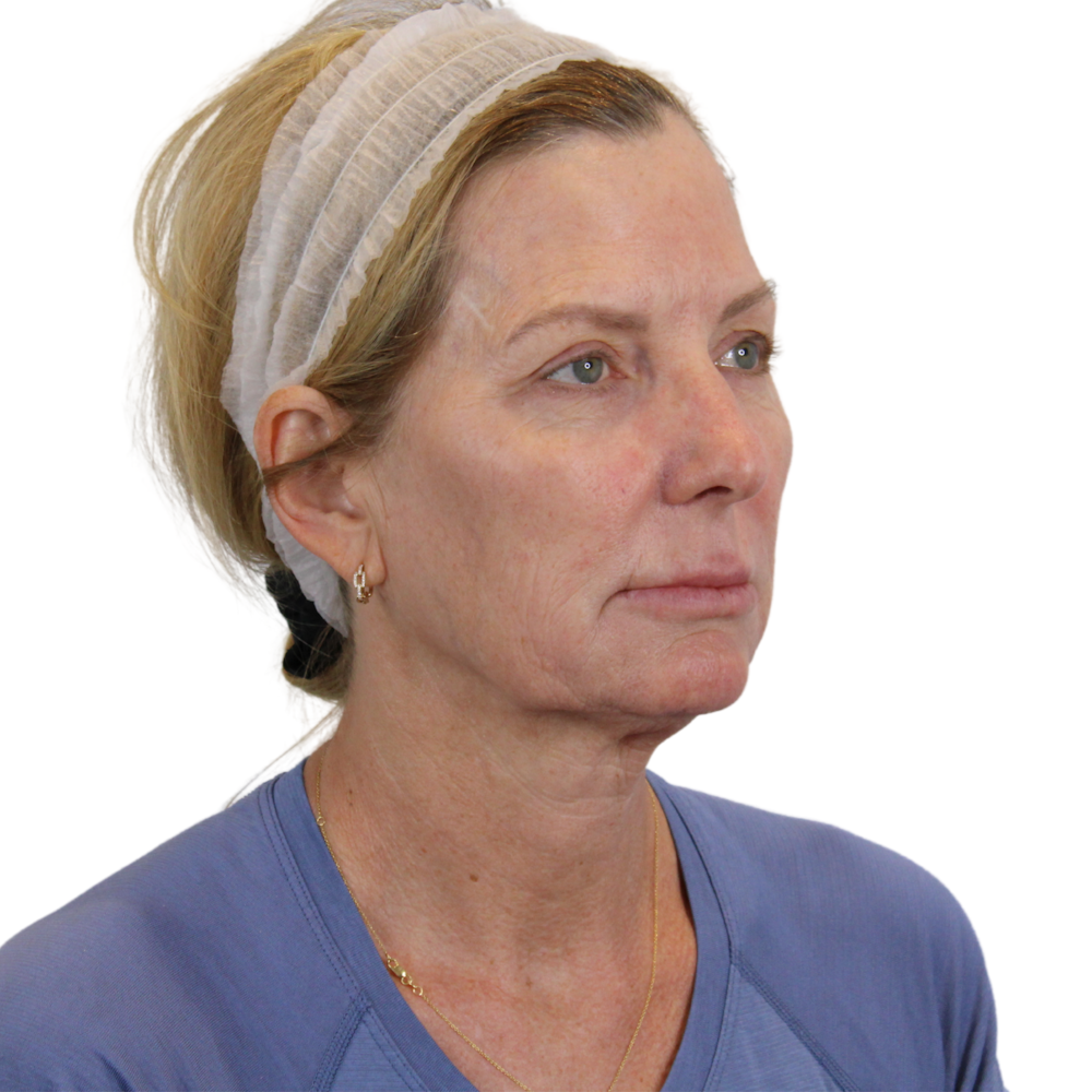 Deep Plane Facelift Before & After Gallery - Patient 207855 - Image 3