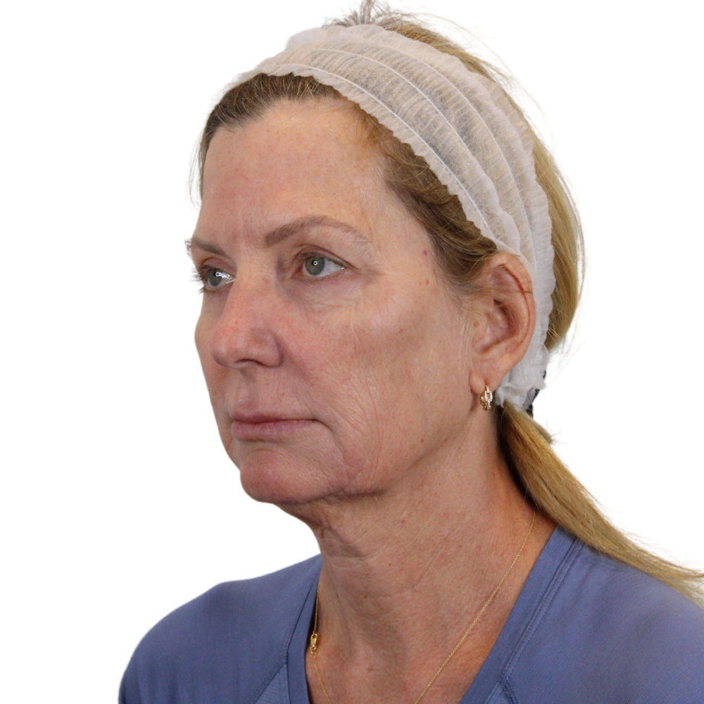 Deep Plane Facelift Before & After Gallery - Patient 207855 - Image 9