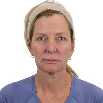 Deep Plane Facelift Before & After Gallery - Patient 207855 - Image 1