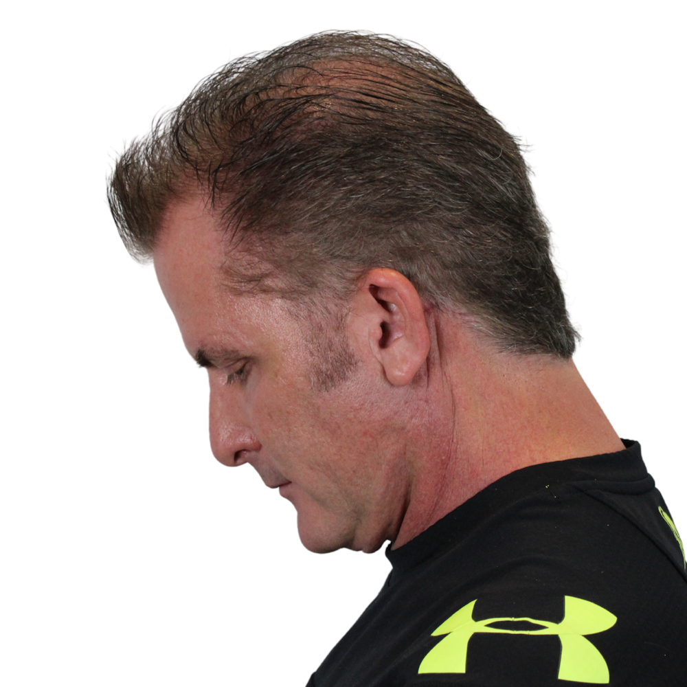 Deep Plane Facelift Before & After Gallery - Patient 308004 - Image 14