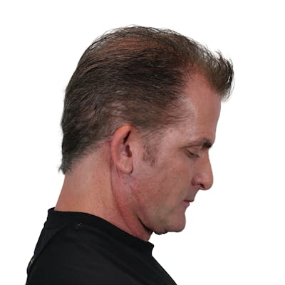 Deep Plane Facelift Before & After Gallery - Patient 308004 - Image 8