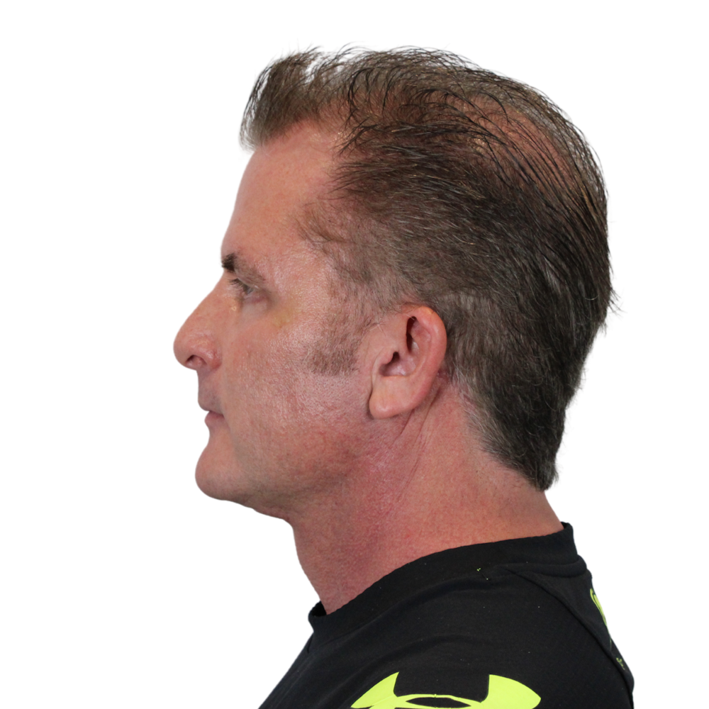Deep Plane Facelift Before & After Gallery - Patient 308004 - Image 12