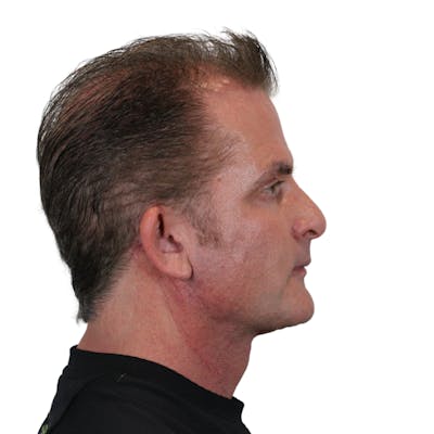 Deep Plane Facelift Before & After Gallery - Patient 308004 - Image 6