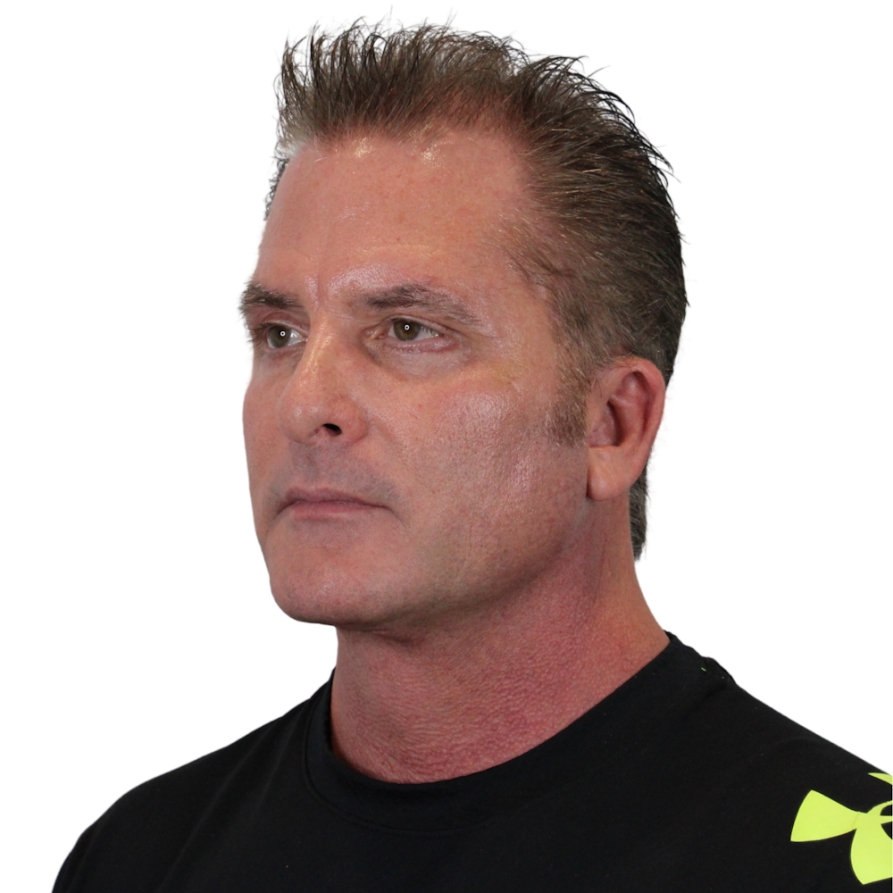 Deep Plane Facelift Before & After Gallery - Patient 308004 - Image 9