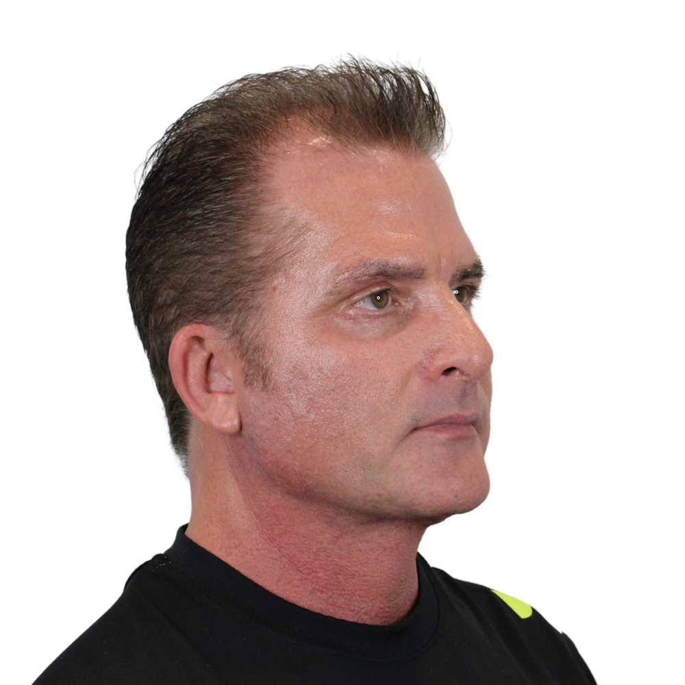 Deep Plane Facelift Before & After Gallery - Patient 308004 - Image 4