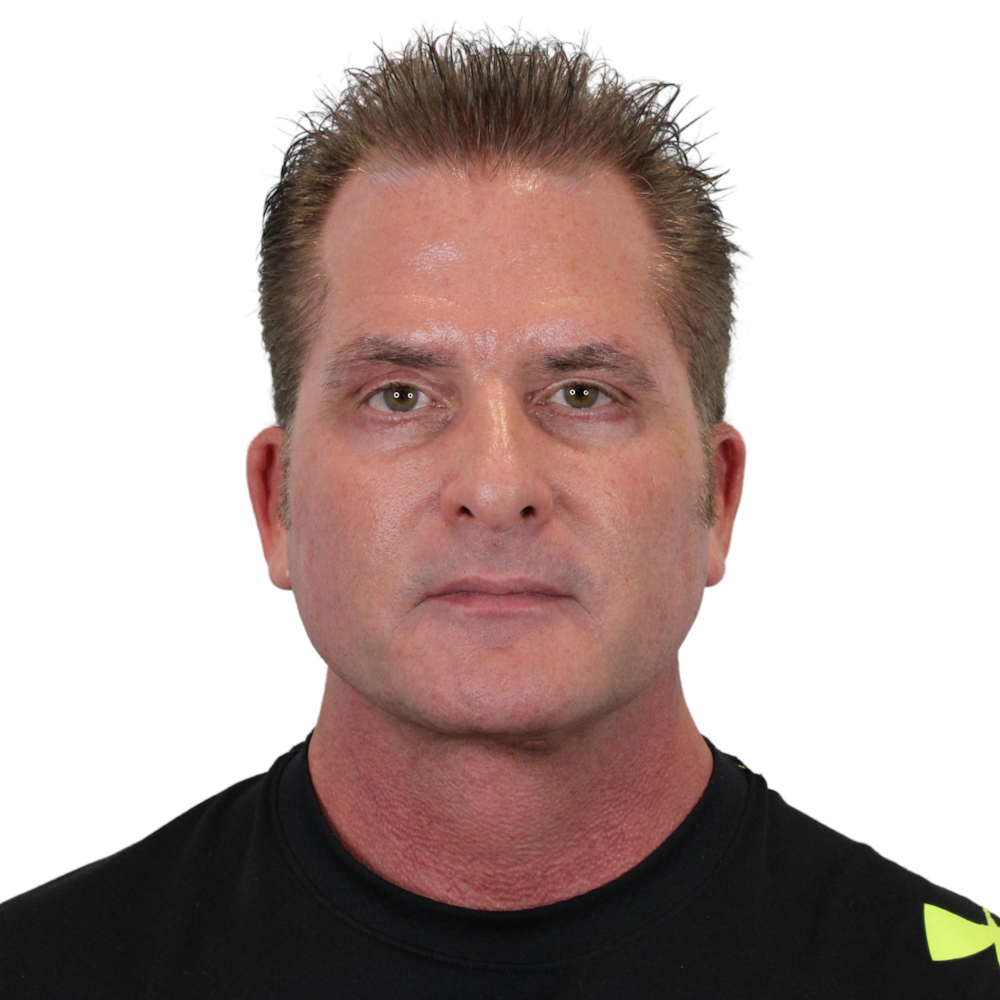 Deep Plane Facelift Before & After Gallery - Patient 308004 - Image 2