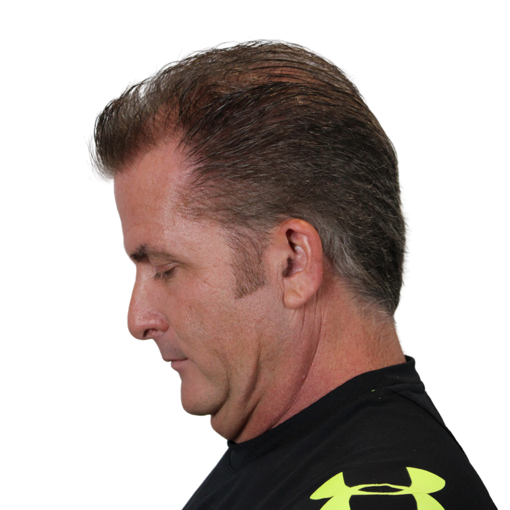 Deep Plane Facelift Before & After Gallery - Patient 308004 - Image 13