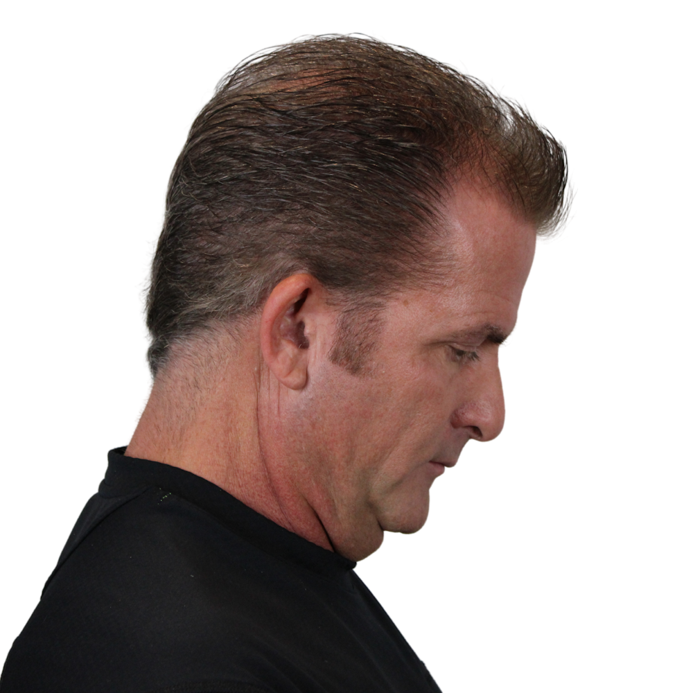 Deep Plane Facelift Before & After Gallery - Patient 308004 - Image 7