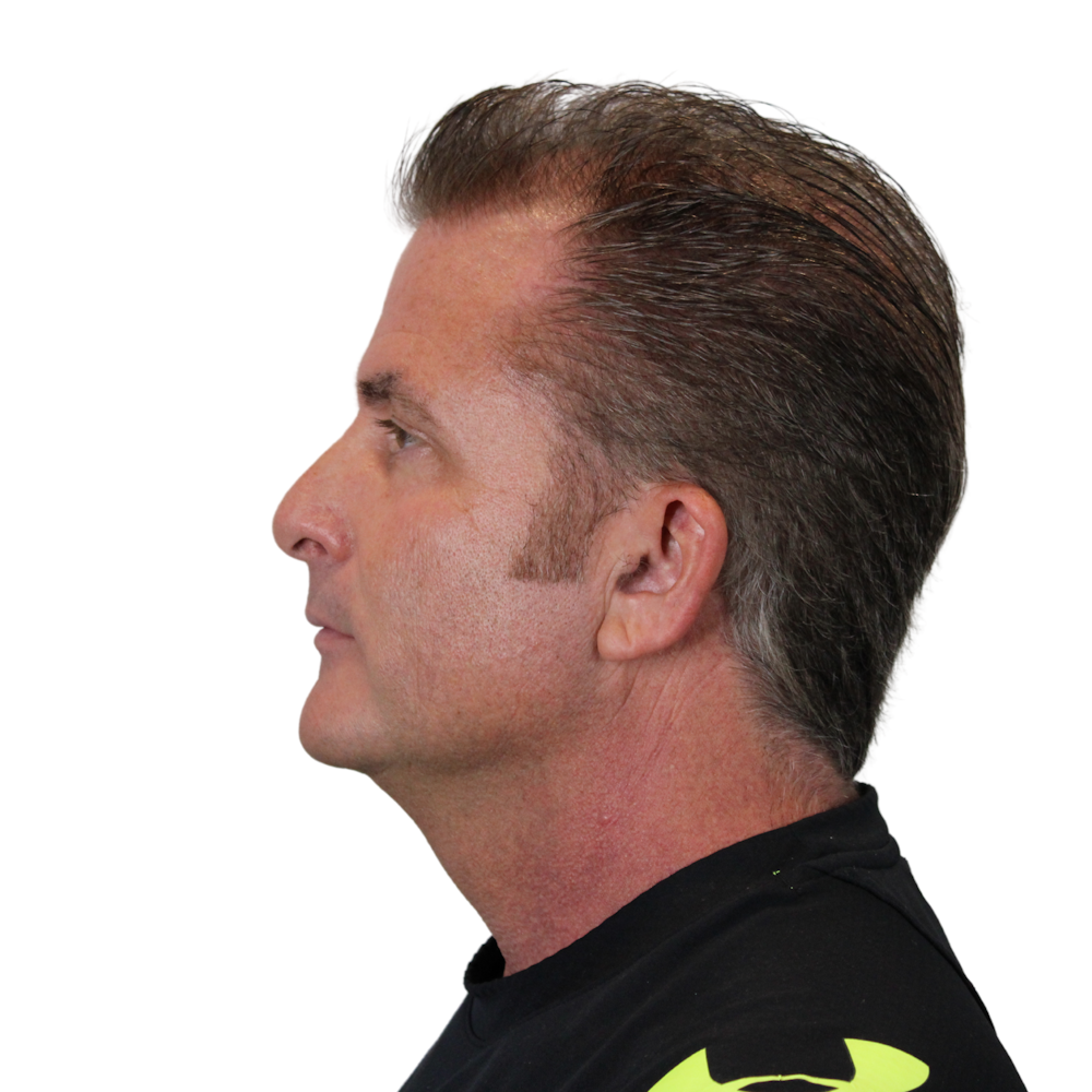 Deep Plane Facelift Before & After Gallery - Patient 308004 - Image 11