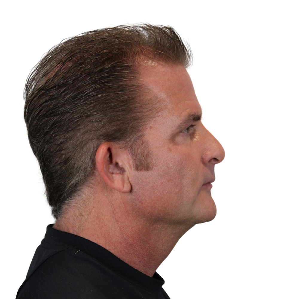 Deep Plane Facelift Before & After Gallery - Patient 308004 - Image 5