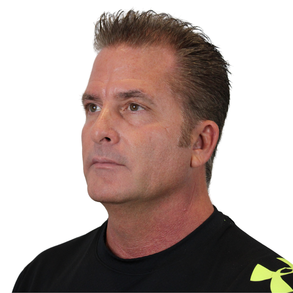 Deep Plane Facelift Before & After Gallery - Patient 308004 - Image 10