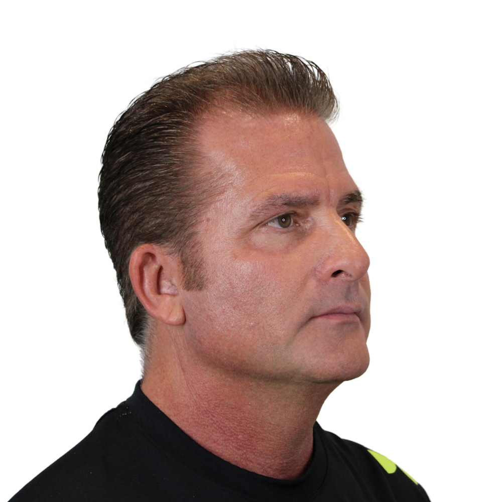 Deep Plane Facelift Before & After Gallery - Patient 308004 - Image 3