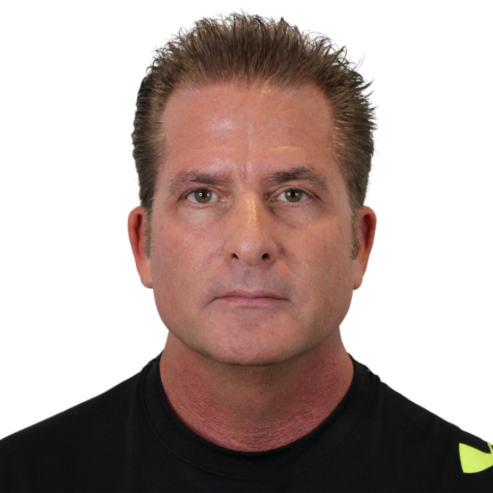 Deep Plane Facelift Before & After Gallery - Patient 308004 - Image 1