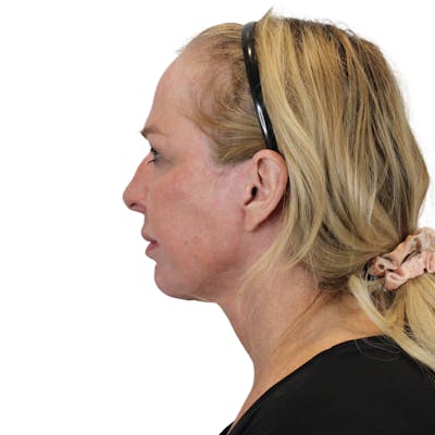 Deep Plane Facelift Before & After Gallery - Patient 949455 - Image 10