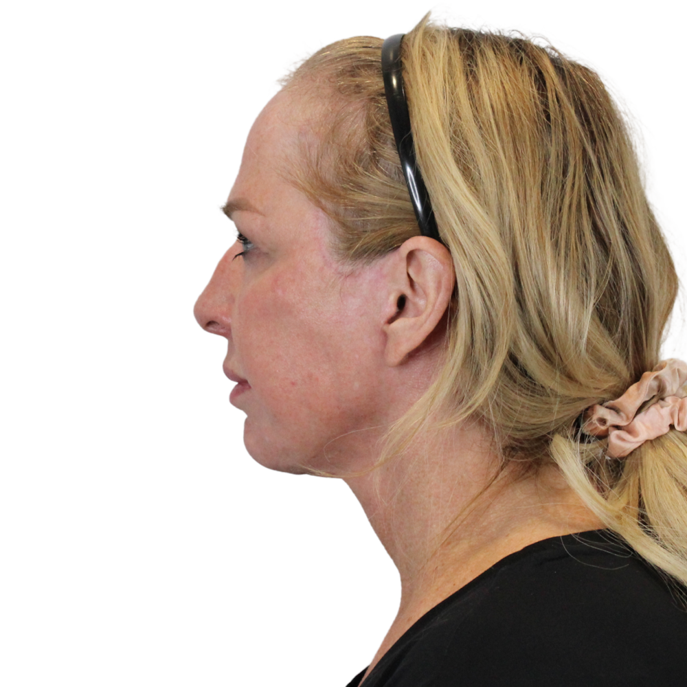 Deep Plane Facelift Before & After Gallery - Patient 949455 - Image 10