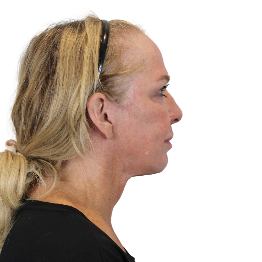 Deep Plane Facelift Before & After Gallery - Patient 949455 - Image 6