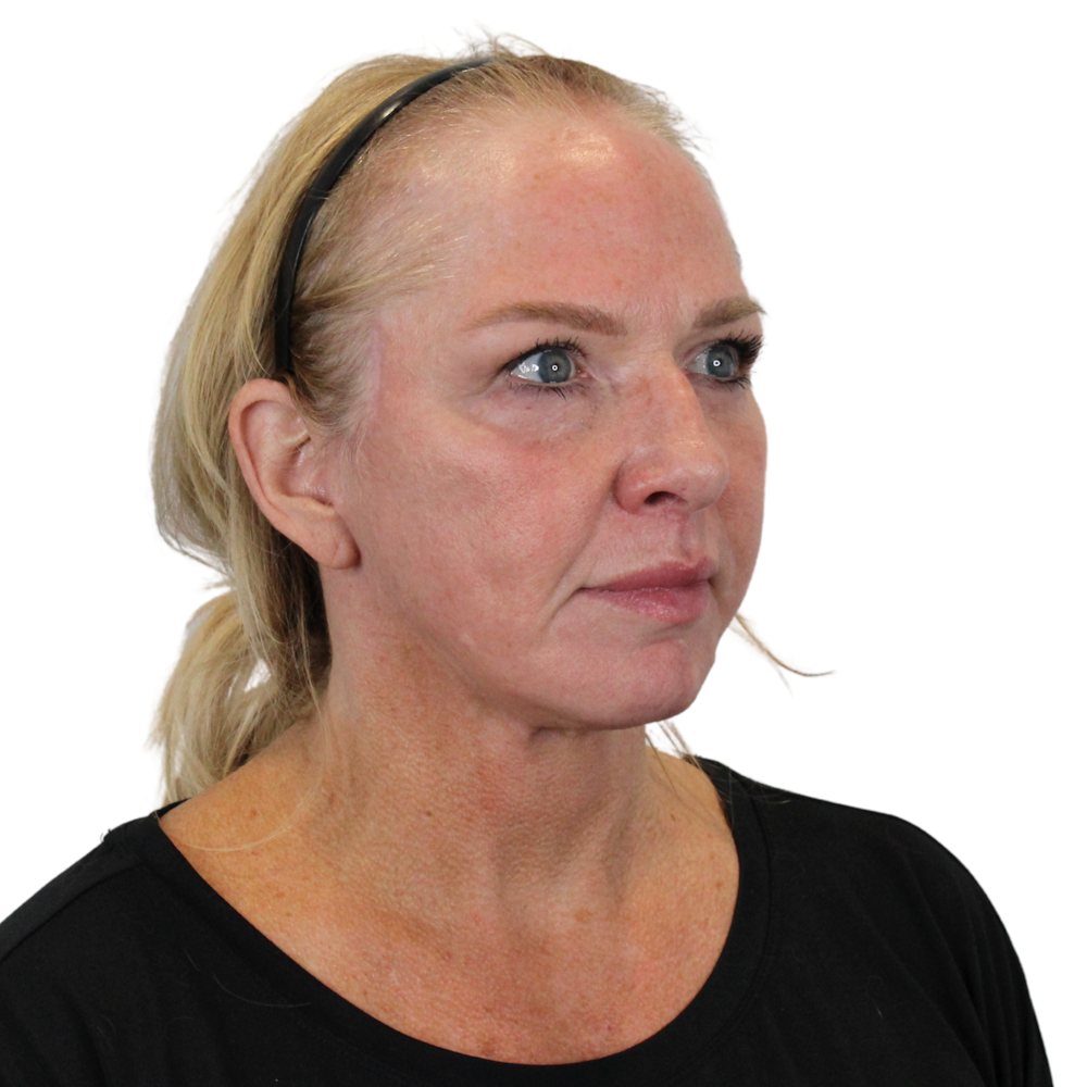Deep Plane Facelift Before & After Gallery - Patient 949455 - Image 4