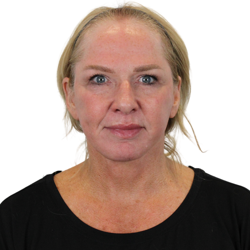 Deep Plane Facelift Before & After Gallery - Patient 949455 - Image 2