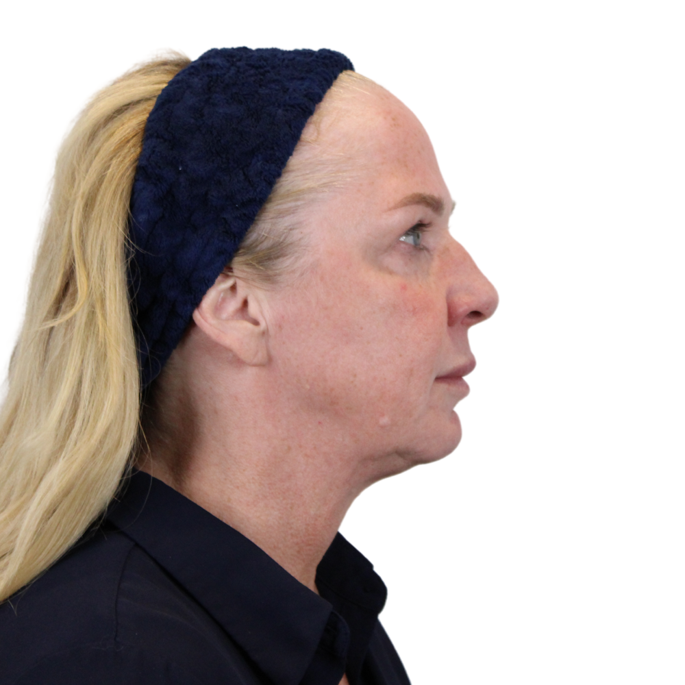 Deep Plane Facelift Before & After Gallery - Patient 949455 - Image 5