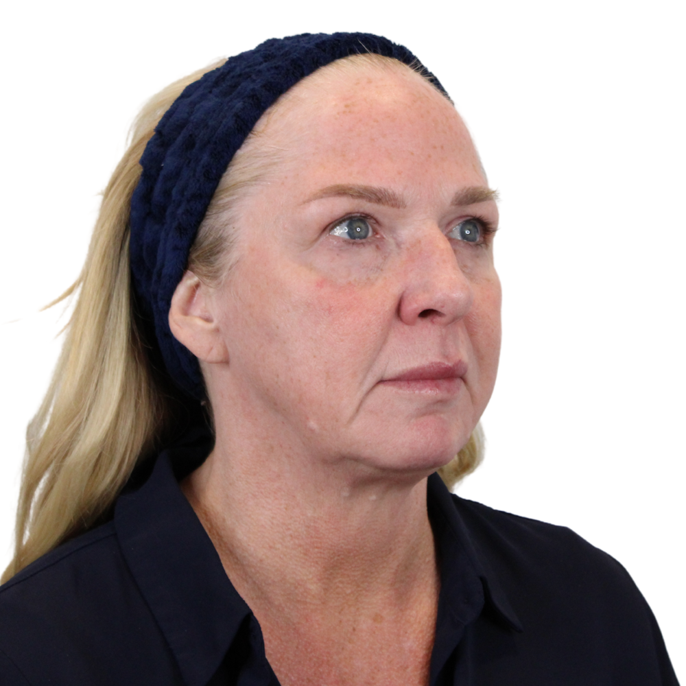Deep Plane Facelift Before & After Gallery - Patient 949455 - Image 3