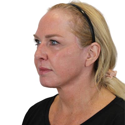 Deep Plane Facelift Before & After Gallery - Patient 949455 - Image 8