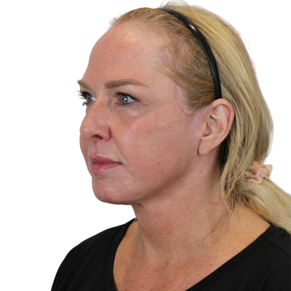 Deep Plane Facelift Before & After Gallery - Patient 949455 - Image 8