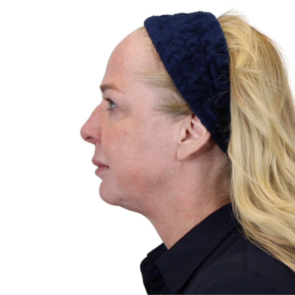Deep Plane Facelift Before & After Gallery - Patient 949455 - Image 9