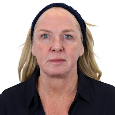 Deep Plane Facelift Before & After Gallery - Patient 949455 - Image 1
