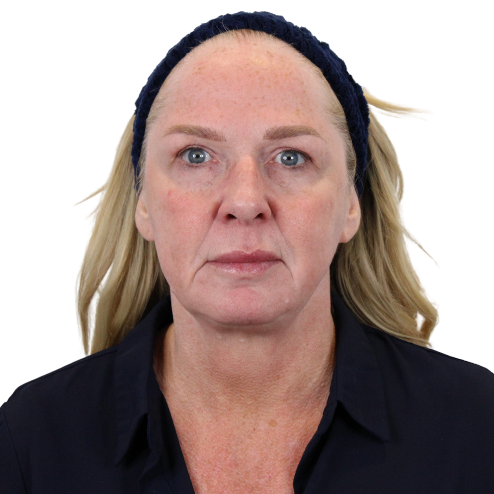 Deep Plane Facelift Before & After Gallery - Patient 949455 - Image 1