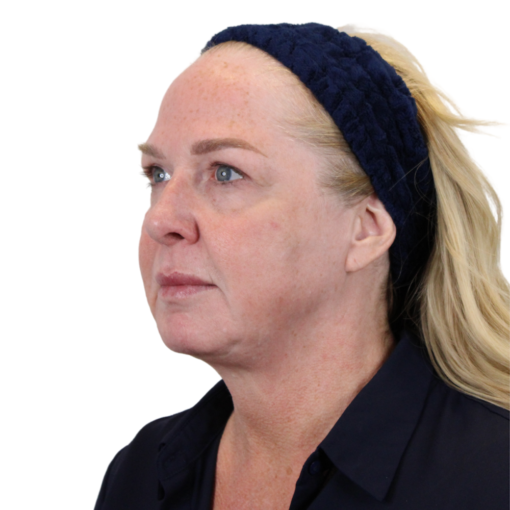 Deep Plane Facelift Before & After Gallery - Patient 949455 - Image 7