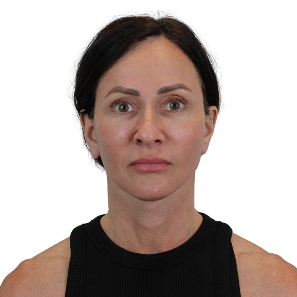 Deep Plane Facelift Before & After Gallery - Patient 329237 - Image 2