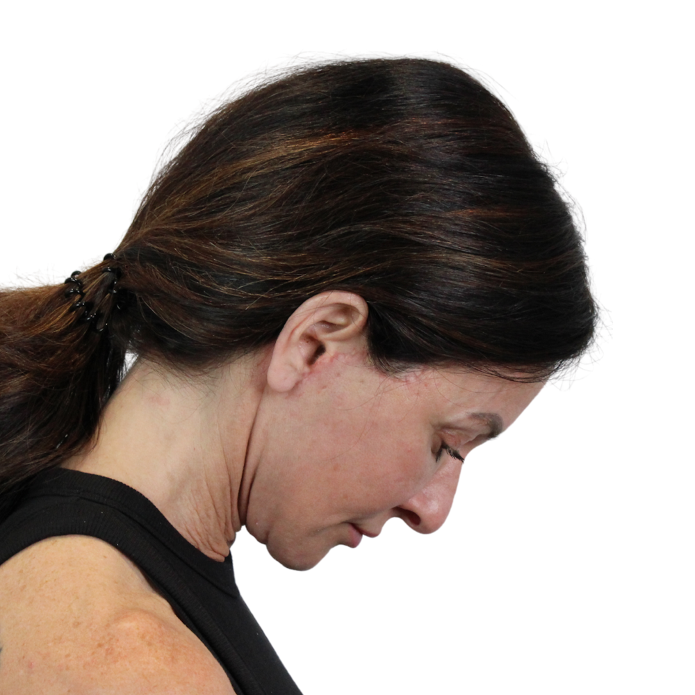 Deep Plane Facelift Before & After Gallery - Patient 329237 - Image 8
